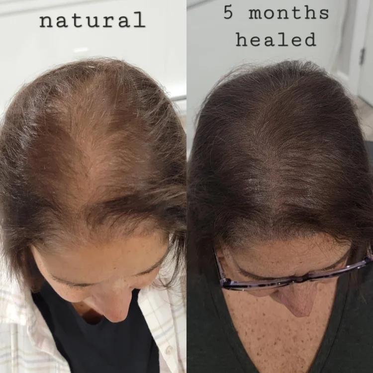 Scalp Micropigmentation success before and after