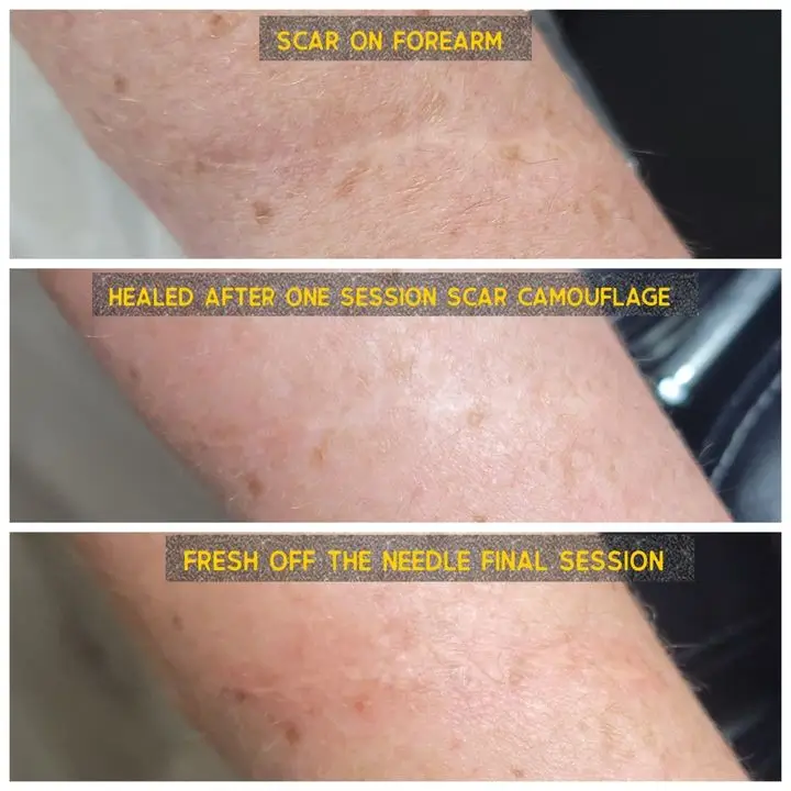 Paramedical tattooing - scar camouflage